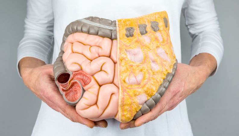 síndrome do intestino irritável