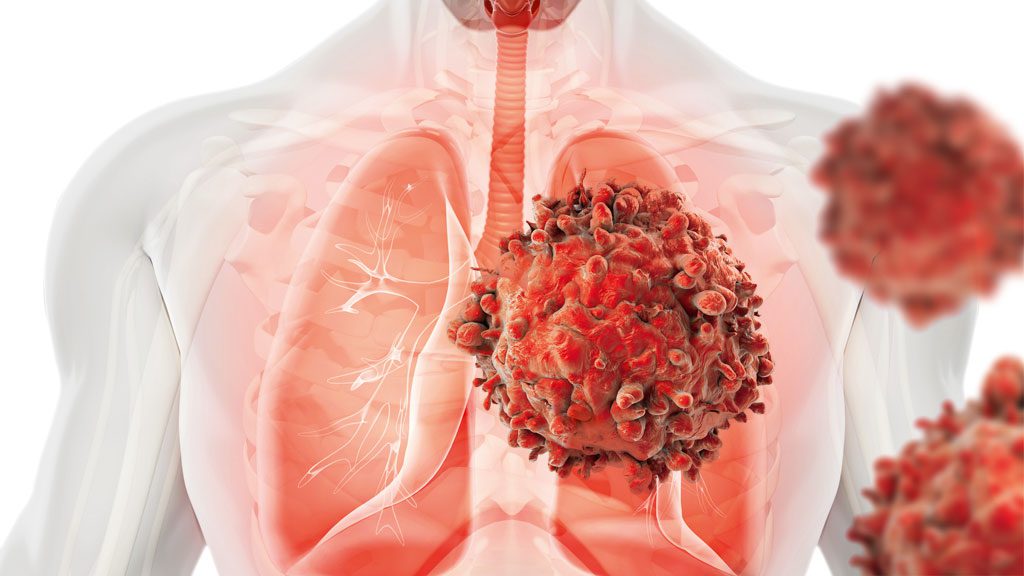 microbioma e câncer