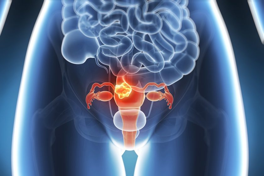 câncer cervical
